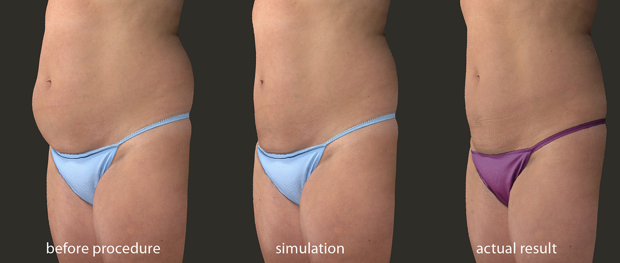 Visualize Your Breast Augmentation Results with Vectra 3D- Bay Area San  Francisco