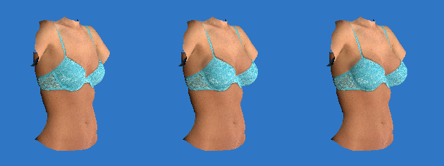 Visualize Your Breast Augmentation Results with Vectra 3D- Bay